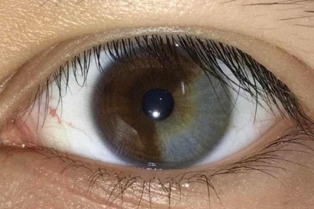 Half Eye Heterochromia Melanin