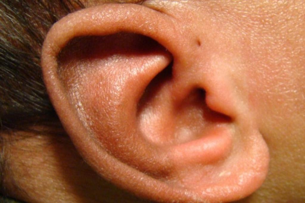 Ear Trait Preauricular Pits