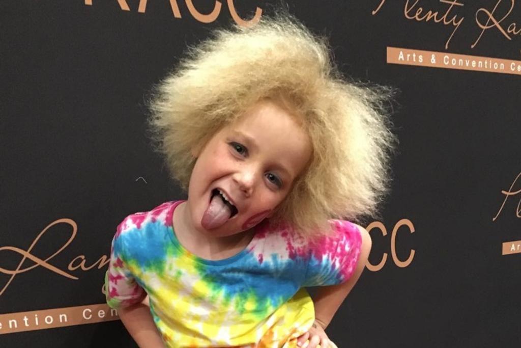 Shilah Uncombable Hair Syndrome