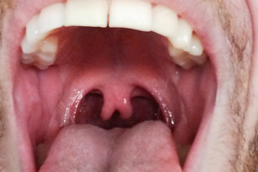 Bifid Uvula Genetic Mutation