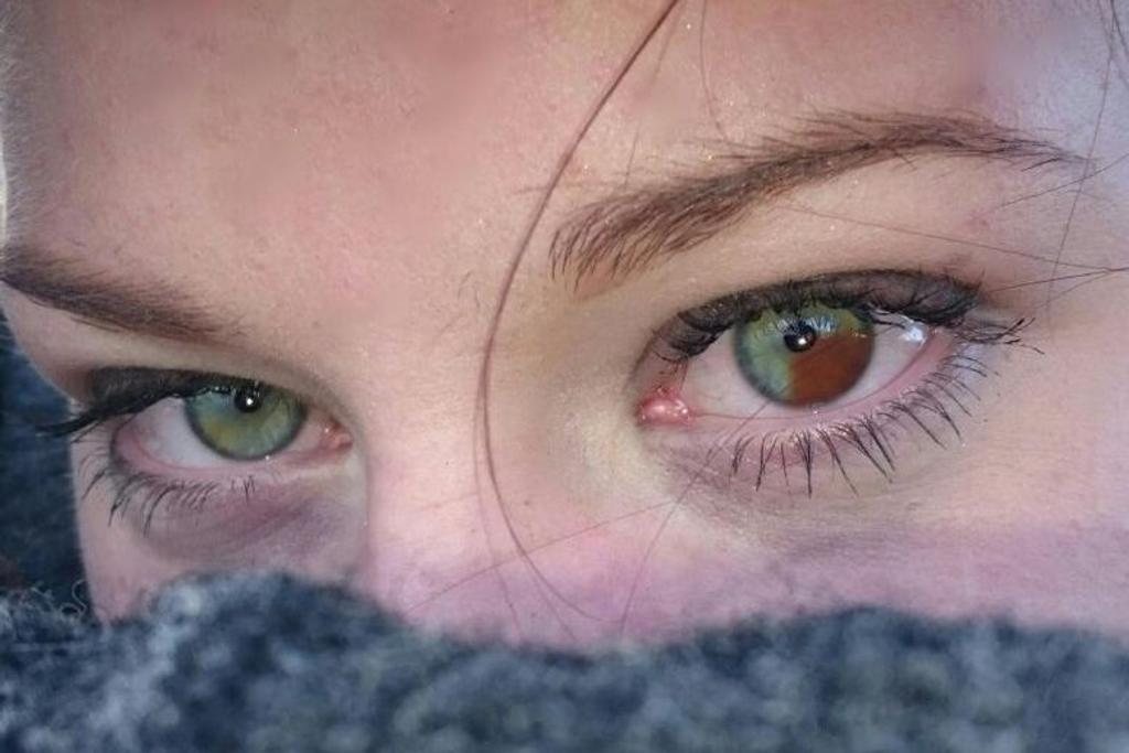 heterchromia markings eyes pictures