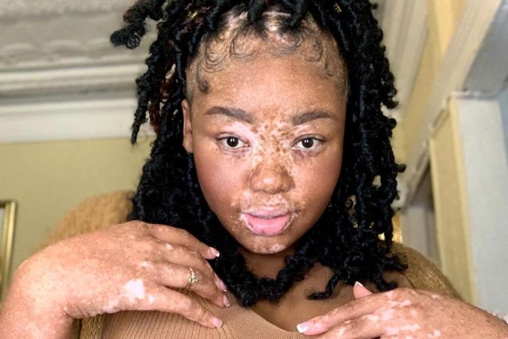 beautiful vitiligo unique marks 