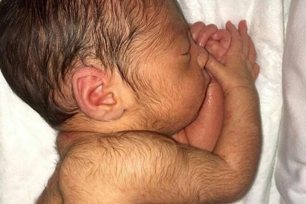 unique genetic conditions babies