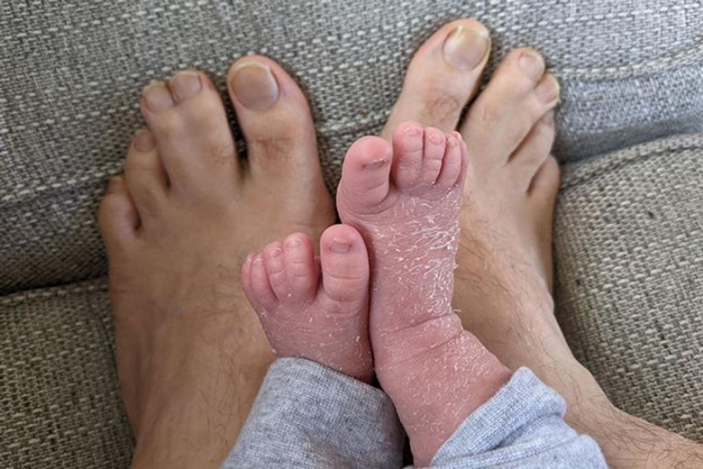 genetic joint toes condition