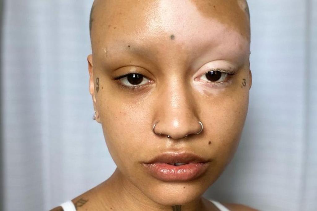 vitiligo rare genetic condition