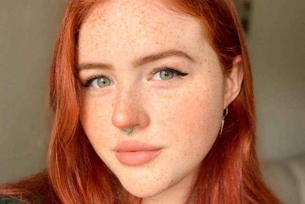 Freckles rare genetic unique